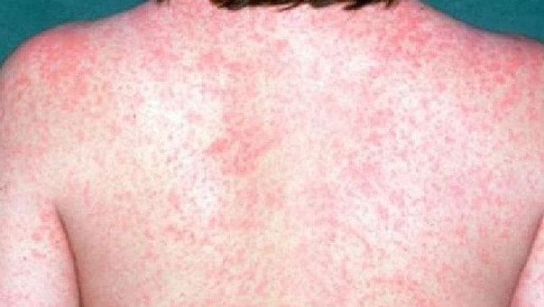 measles